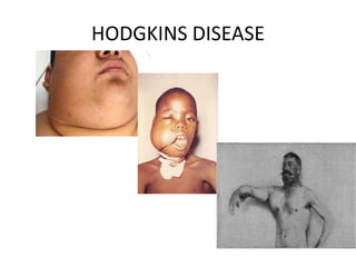 HODGKINS DISEASE