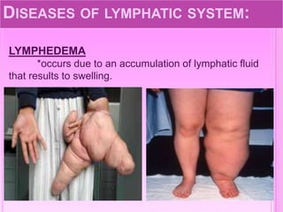 DISEASES OF LYMPHATIC SYSTEM:
LYMPHEDEMA
*occurs due to an accumulation of lymphatic fluid
that results to swelling.
 