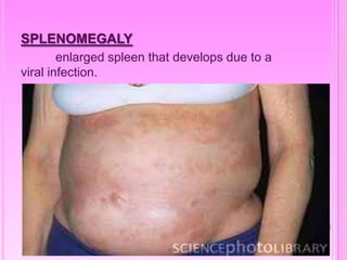 SPLENOMEGALY
enlarged spleen that develops due to a
viral infection.
 