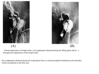 Normal appearance of lymph nodes. (a) Lymphogram obtained during the filling phase shows a
homogeneous appearance of the lymph nodes.
(b) Lymphogram obtained during the nodal phase shows a smooth peripheral indentation (arrowheads),
which corresponds to the hilar area.
.
(A) (B)
 
