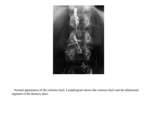 Normal appearance of the cisterna chyli. Lymphogram shows the cisterna chyli and the abdominal
segment of the thoracic duct.
 