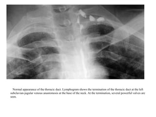 Normal appearance of the thoracic duct. Lymphogram shows the termination of the thoracic duct at the left
subclavian-jugular venous anastomosis at the base of the neck. At the termination, several powerful valves are
seen.
 