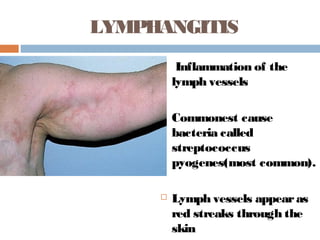 LYMPHANGITIS
  Inflammation of the
lymph vessels
 Commonest cause
bacteria called
streptococcus
pyogenes(most common).
 Lymph vessels appearas
red streaks through the
skin
 