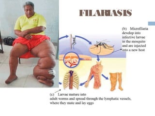 FILARIASIS
 