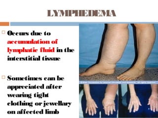 LYMPHEDEMA
 Occurs due to
accumulation of
lymphatic fluid in the
interstitial tissue
 Sometimes can be
appreciated after
wearing tight
clothing orjewellary
on affected limb
 