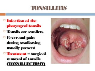 TONSILLITIS
 Infection of the
pharyngeal tonsils
 Tonsils are swollen,
 Feverand pain
during swallowing
usually present
 Treatment – surgical
removal of tonsils
(TONSILLECTOMY)
 