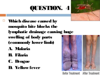  Which disease caused by
mosquito bite blocks the
lymphatic drainage causing huge
swelling of body parts
(commonly lowerlimb)
A. Malaria
B. Filaria
C. Dengue
D. Yellow fever
QUESTION. 4
 