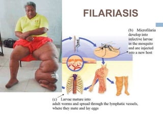 FILARIASIS
 