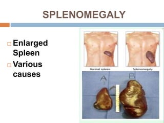 SPLENOMEGALY
 Enlarged
Spleen
 Various
causes
 