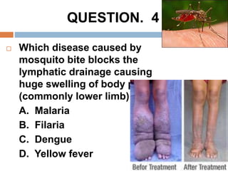  Which disease caused by
mosquito bite blocks the
lymphatic drainage causing
huge swelling of body parts
(commonly lower limb)
A. Malaria
B. Filaria
C. Dengue
D. Yellow fever
QUESTION. 4
 