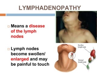 LYMPHADENOPATHY
 Means a disease
of the lymph
nodes
 Lymph nodes
become swollen/
enlarged and may
be painful to touch
 