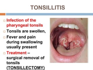 TONSILLITIS
 Infection of the
pharyngeal tonsils
 Tonsils are swollen,
 Fever and pain
during swallowing
usually present
 Treatment –
surgical removal of
tonsils
(TONSILLECTOMY)
 