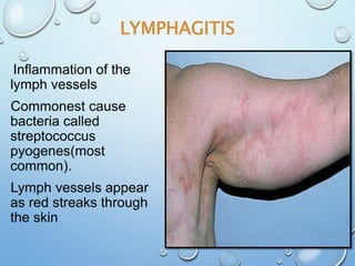 LYMPHAGITIS
31
Inflammation of the
lymph vessels
Commonest cause
bacteria called
streptococcus
pyogenes(most
common).
Lymph vessels appear
as red streaks through
the skin
 