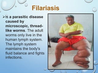 32
Filariasis
is a parasitic disease
caused by
microscopic, thread-
like worms. The adult
worms only live in the
human lymph system.
The lymph system
maintains the body's
fluid balance and fights
infections.
 