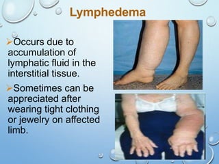 33
Lymphedema
Occurs due to
accumulation of
lymphatic fluid in the
interstitial tissue.
Sometimes can be
appreciated after
wearing tight clothing
or jewelry on affected
limb.
 