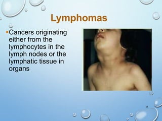 34
Lymphomas
Cancers originating
either from the
lymphocytes in the
lymph nodes or the
lymphatic tissue in
organs
 