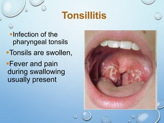 36
Tonsillitis
Infection of the
pharyngeal tonsils
Tonsils are swollen,
Fever and pain
during swallowing
usually present
 