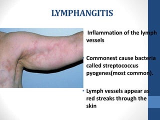 LYMPHANGITIS
• Inflammation of the lymph
vessels
• Commonest cause bacteria
called streptococcus
pyogenes(most common).
• Lymph vessels appear as
red streaks through the
skin
 
