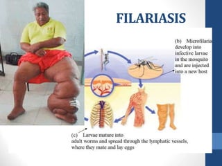 FILARIASIS
 