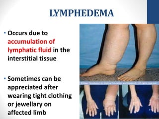 LYMPHEDEMA
• Occurs due to
accumulation of
lymphatic fluid in the
interstitial tissue
• Sometimes can be
appreciated after
wearing tight clothing
or jewellary on
affected limb
 