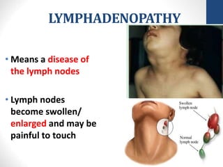 LYMPHADENOPATHY
• Means a disease of
the lymph nodes
• Lymph nodes
become swollen/
enlarged and may be
painful to touch
 