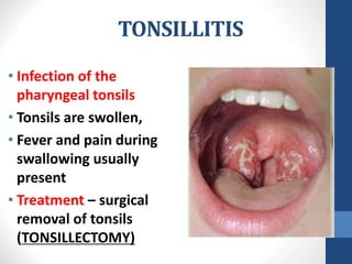 TONSILLITIS
• Infection of the
pharyngeal tonsils
• Tonsils are swollen,
• Fever and pain during
swallowing usually
present
• Treatment – surgical
removal of tonsils
(TONSILLECTOMY)
 