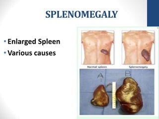 SPLENOMEGALY
•Enlarged Spleen
•Various causes
 