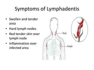Symptoms of LymphadentisSwollen and tender areaHard lymph nodesRed tender skin over lymph nodeInflammation over infected area