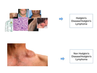 Non Hodgkin's
Disease/Hodgkin's
Lymphoma
Hodgkin's
Disease/Hodgkin's
Lymphoma
 