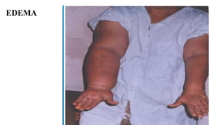EDEMA
 