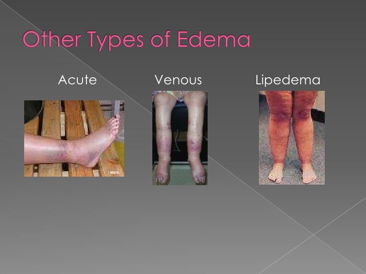 Lymphedema
