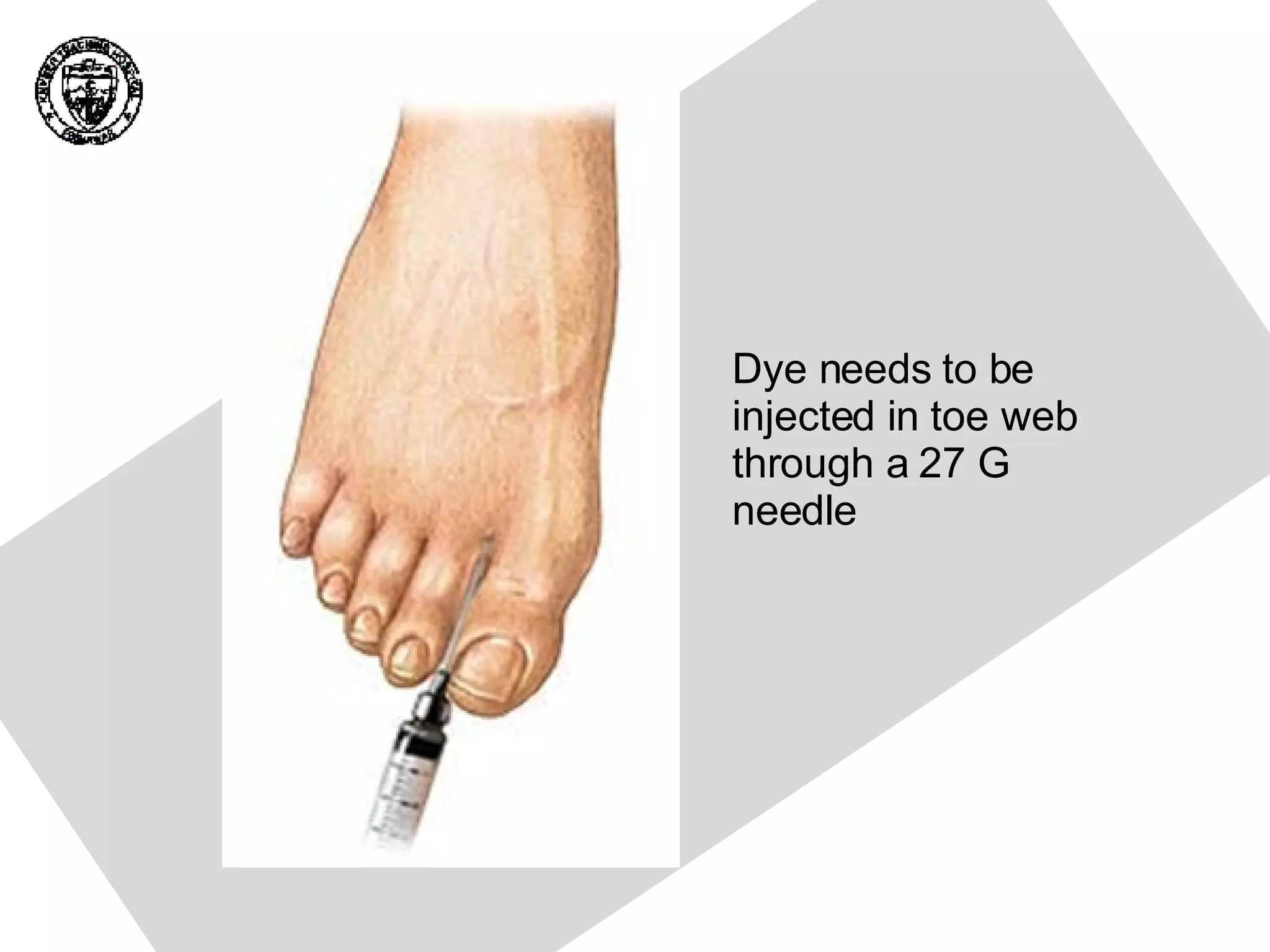 Dye needs to be injected in toe web through a 27 G needle 