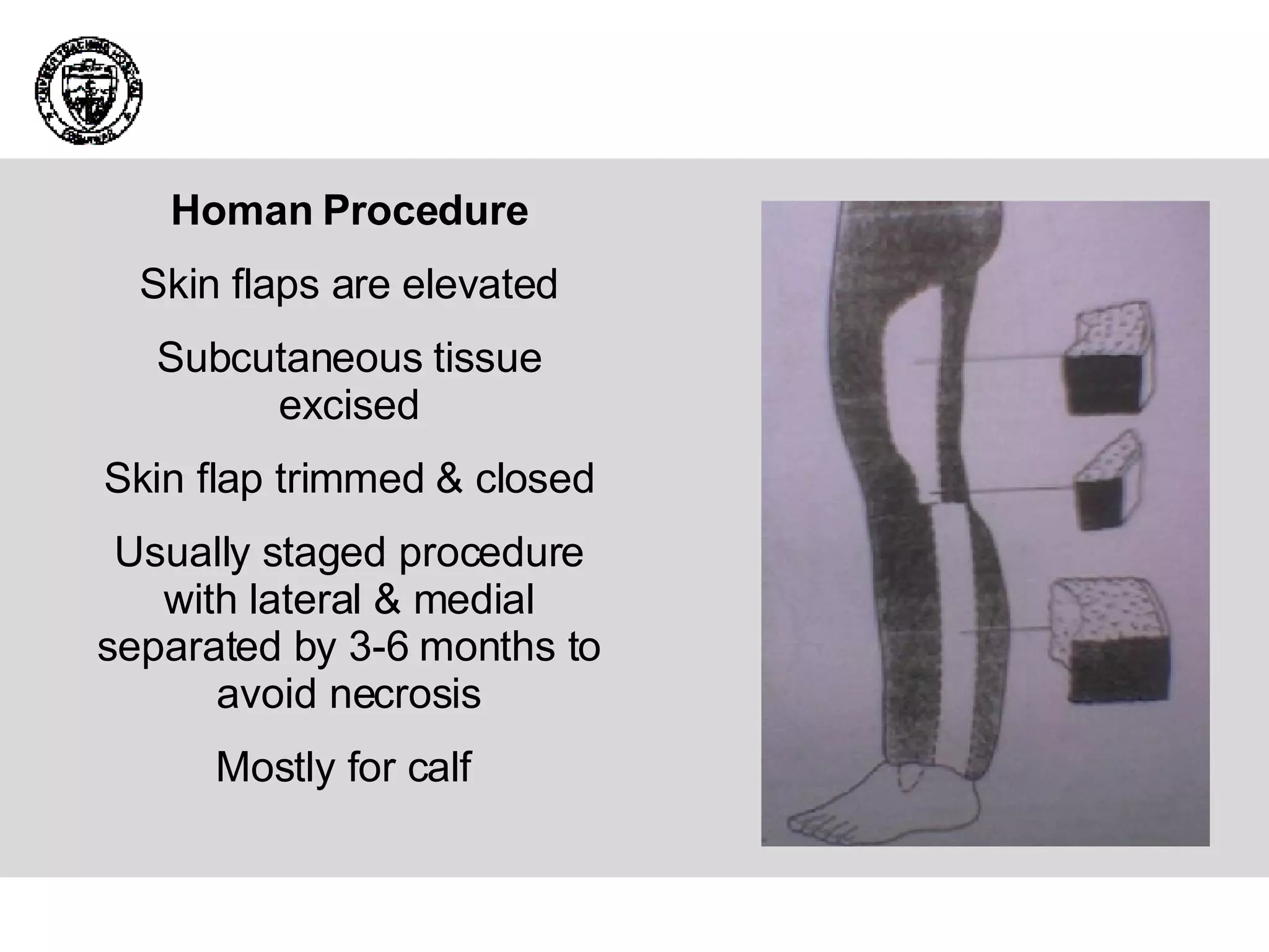 Homan Procedure Skin flaps are elevated Subcutaneous tissue excised Skin flap trimmed & closed Usually staged procedure with lateral & medial separated by 3-6 months to avoid necrosis Mostly for calf  