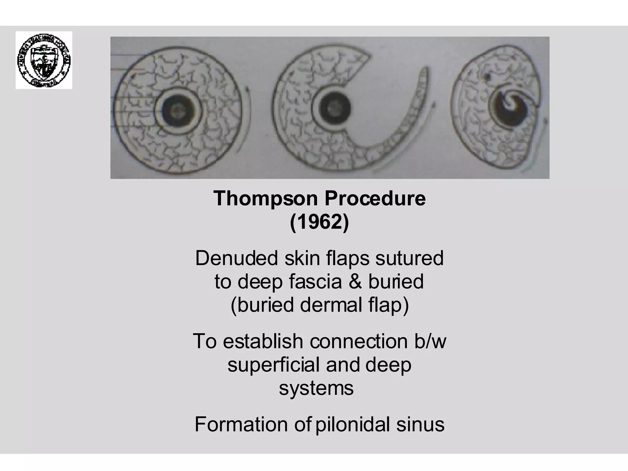 Thompson Procedure (1962) Denuded skin flaps sutured to deep fascia & buried (buried dermal flap) To establish connection b/w superficial and deep systems  Formation of pilonidal sinus 