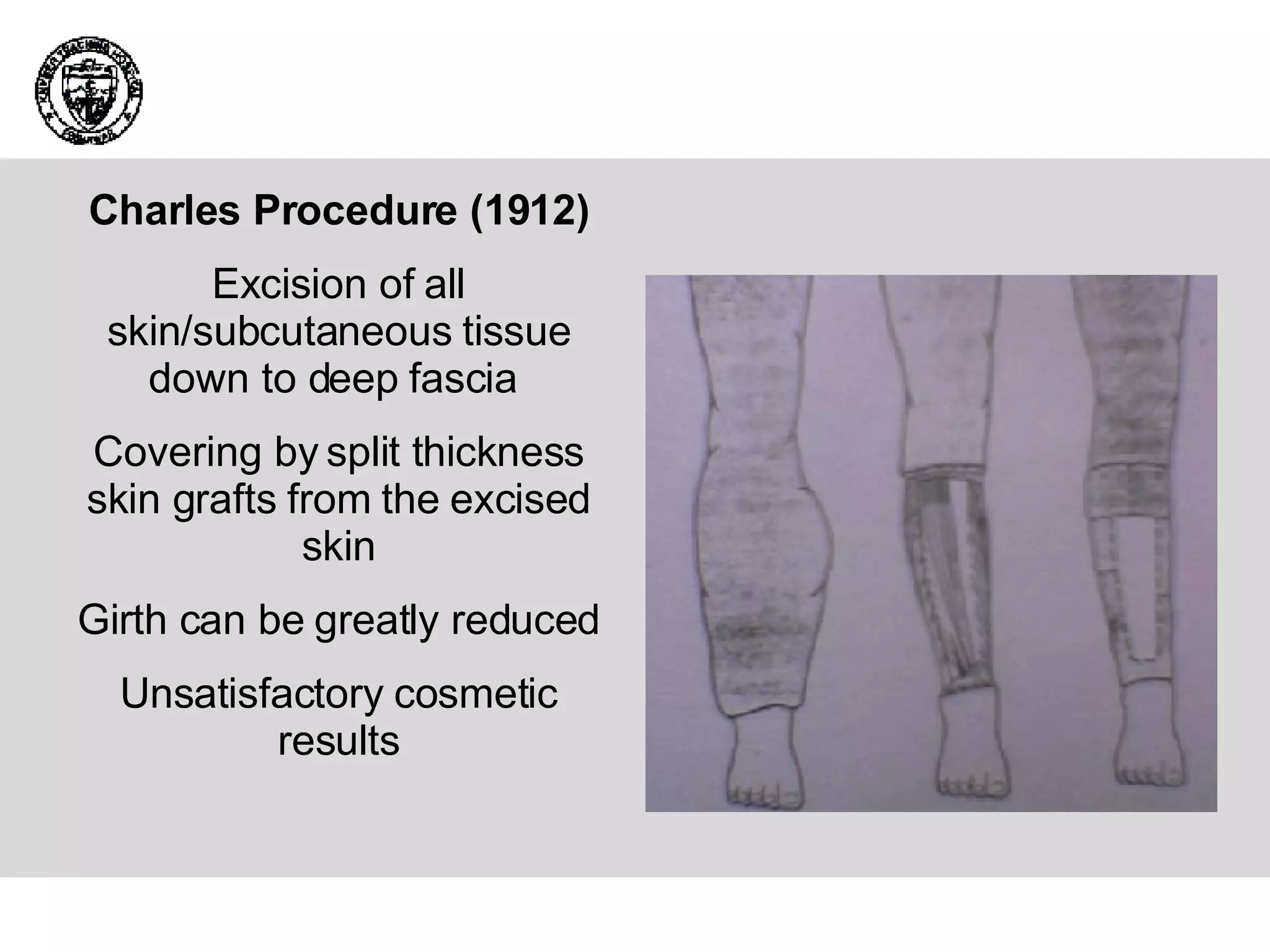 Charles Procedure (1912) Excision of all skin/subcutaneous tissue down to deep fascia  Covering by split thickness skin grafts from the excised skin Girth can be greatly reduced Unsatisfactory cosmetic results 