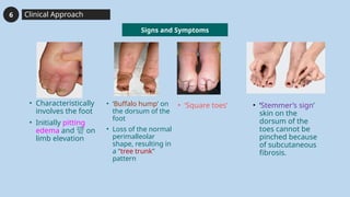 lymphedema internal medicine ppt presentation | PPTX
