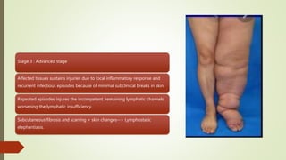 Lymphedema | PPTX