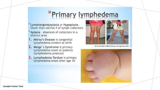Lymphedema Lymphangitis Pathology Pptx