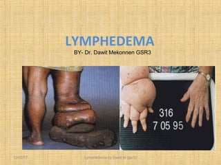 LYMPHEDEMA
12/02/17 Lymphedema by Dawit M (gsr3)
BY- Dr. Dawit Mekonnen GSR3
 