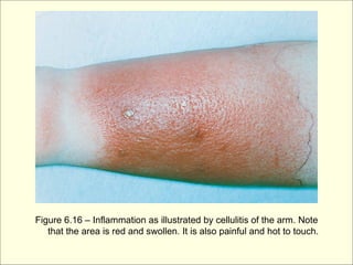 Figure 6.16 – Inflammation as illustrated by cellulitis of the arm. Note
   that the area is red and swollen. It is also painful and hot to touch.
 