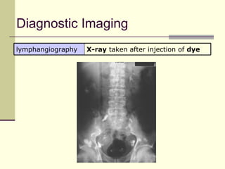 Diagnostic Imaging
lymphangiography   X-ray taken after injection of dye
 