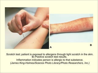 B
                                       A

Scratch test; patient is exposed to allergens through light scratch in the skin.
                        B) Positive scratch test results.
         Inflammation indicates person is allergic to that substance.
   (James King-Holmes/Science Photo Library/Photo Researchers, Inc.)
 
