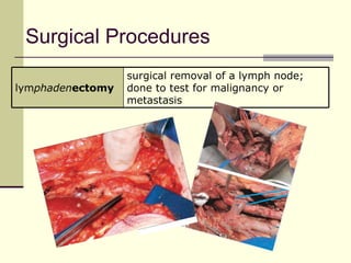Surgical Procedures
                  surgical removal of a lymph node;
lymphadenectomy   done to test for malignancy or
                  metastasis
 