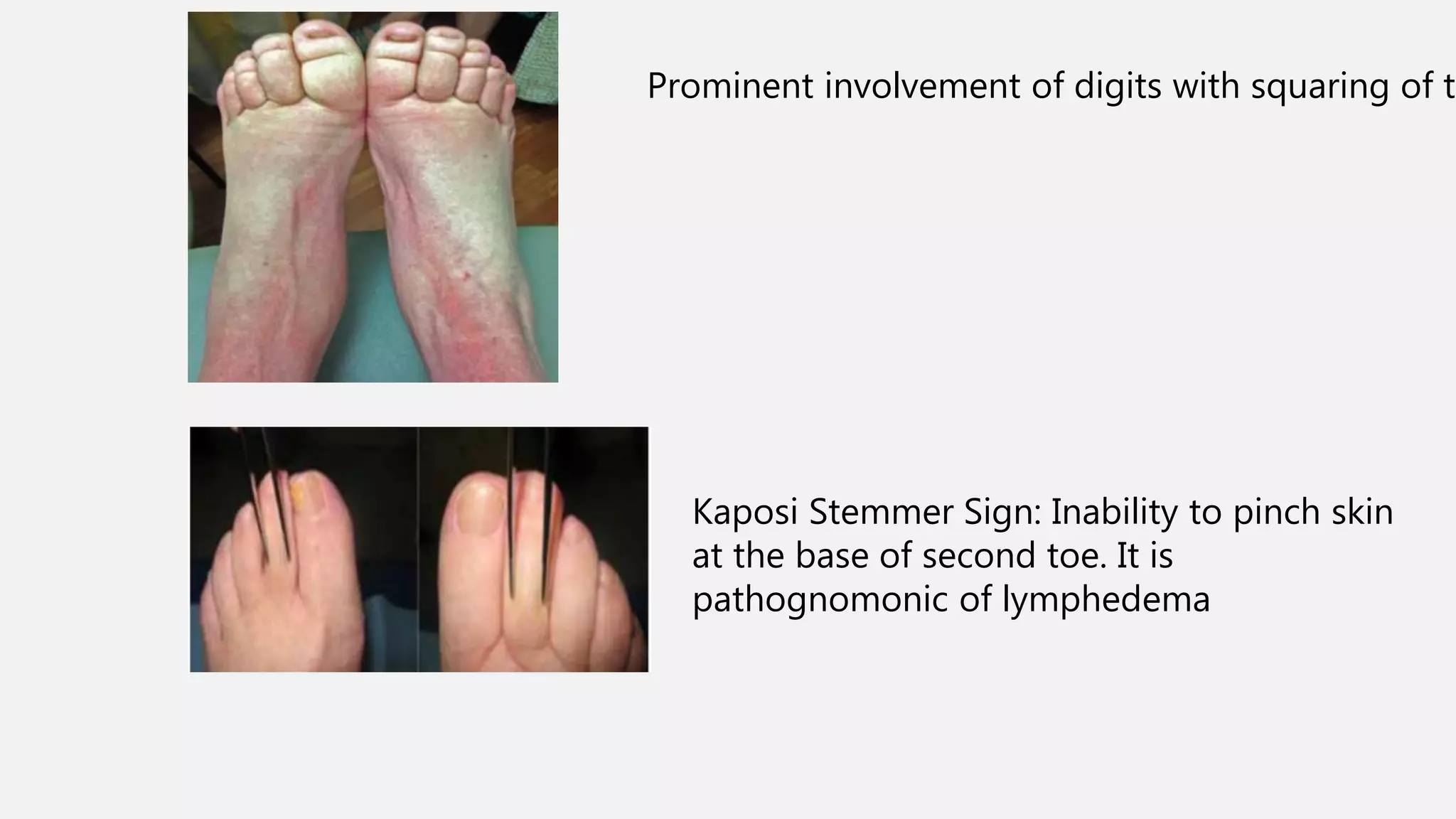 Lymphedema | PPTX