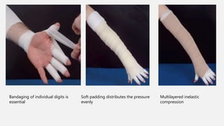 Lymphedema | PPTX