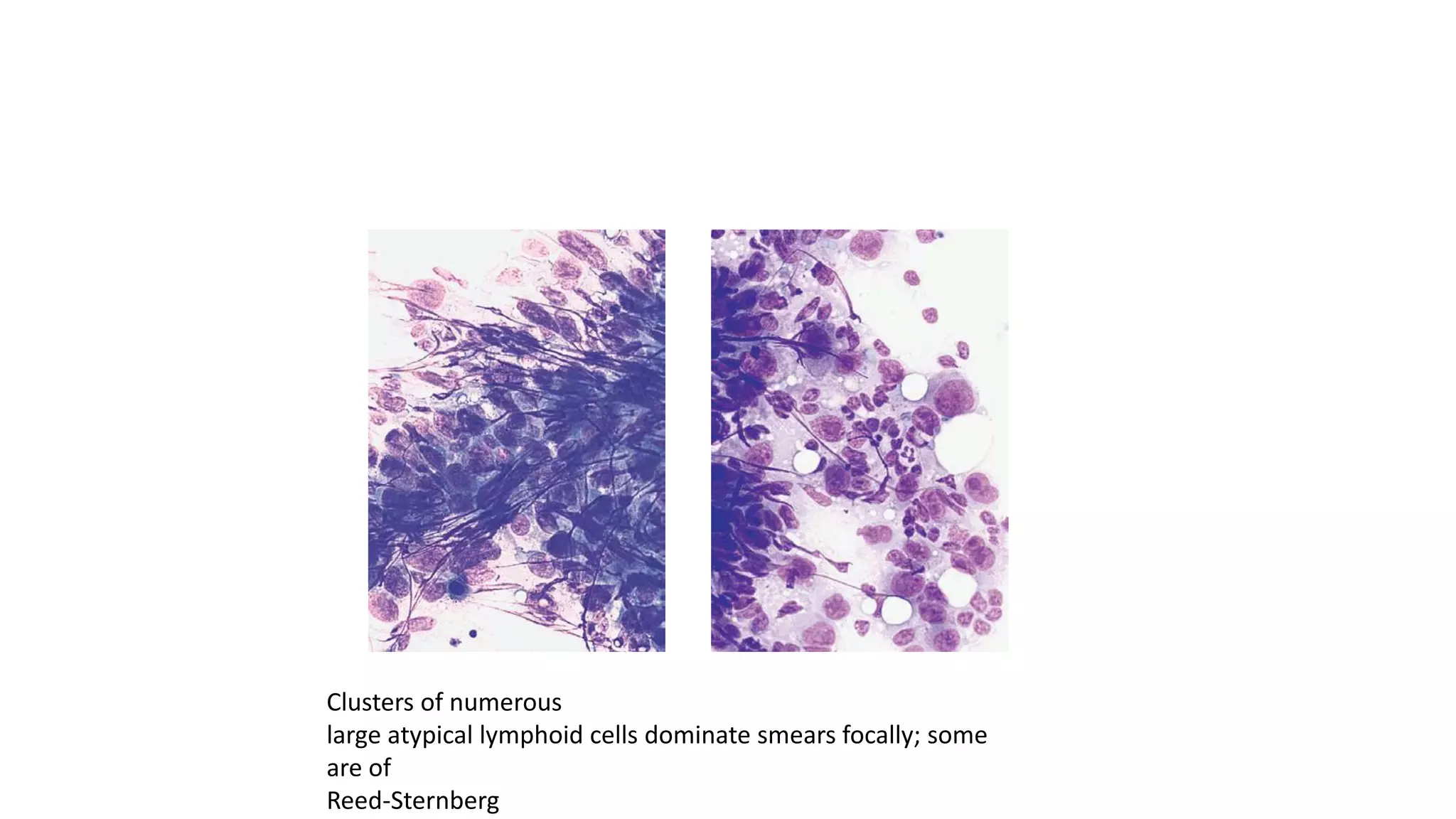 approach to lymph node cytology part 2 | PPTX
