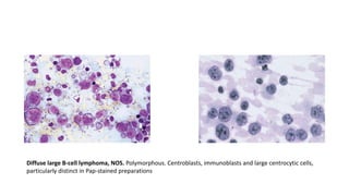 approach to lymph node cytology part 2 | PPTX