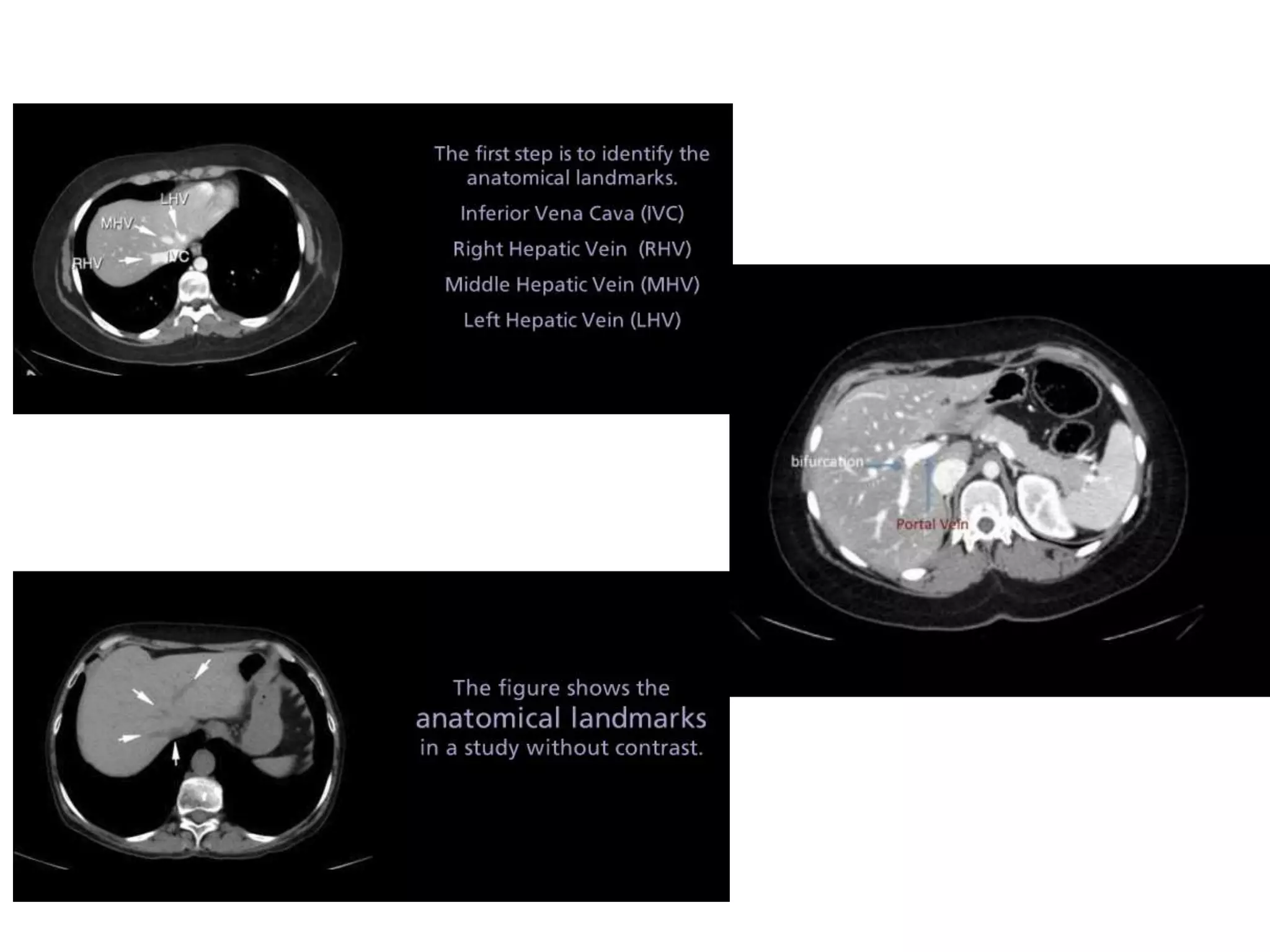 Lymph node anatomy for pet ct | PPTX