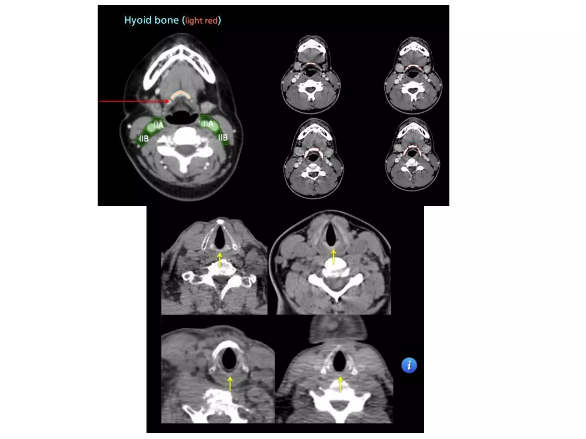 Lymph node anatomy for pet ct | PPTX