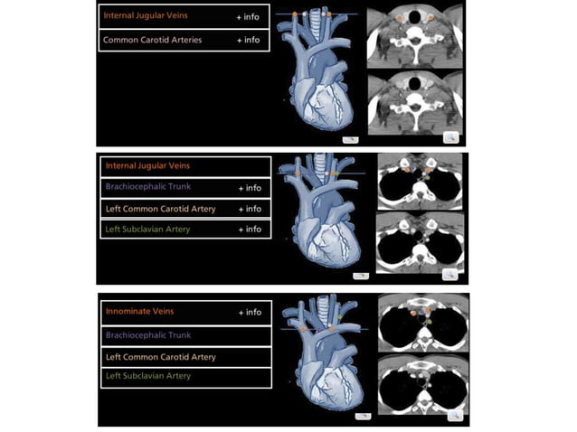 Lymph node anatomy for pet ct | PPT